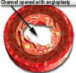 coronary following angioplasty