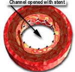 coronary with stent
