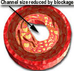 Coronary blockage