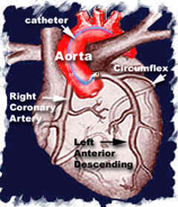 coronary catheter